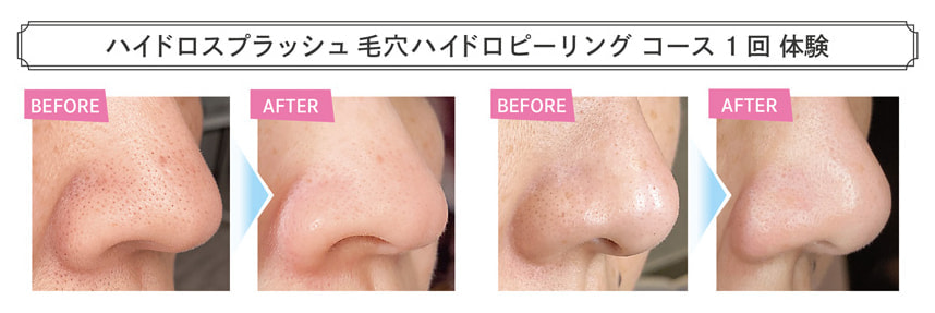 ハイドラフェイシャル